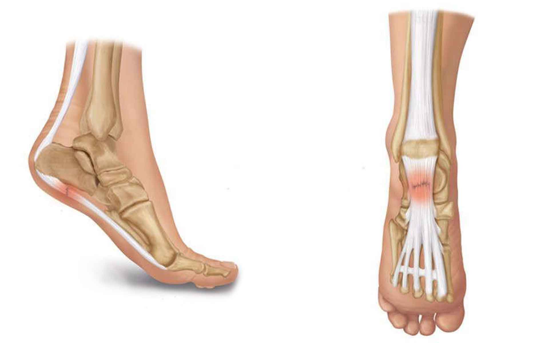 10 ejercicios para el tratamiento de la fascitis plantar