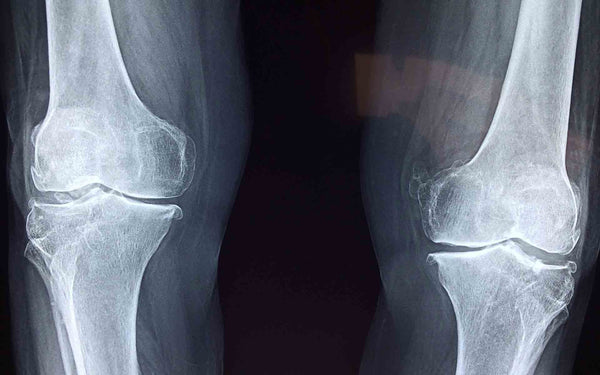 radiografía esguince de rodilla