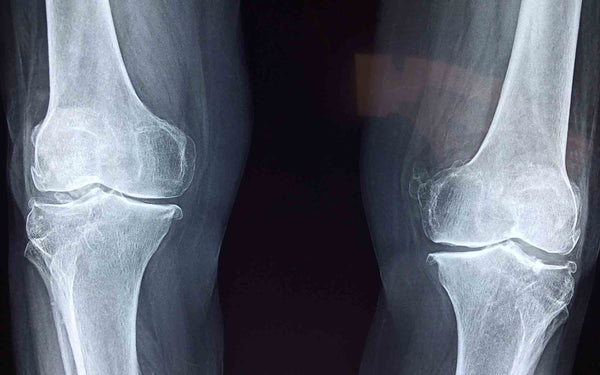 Cómo conseguir un diagnóstico preciso para el tratamiento de un esguince de rodilla