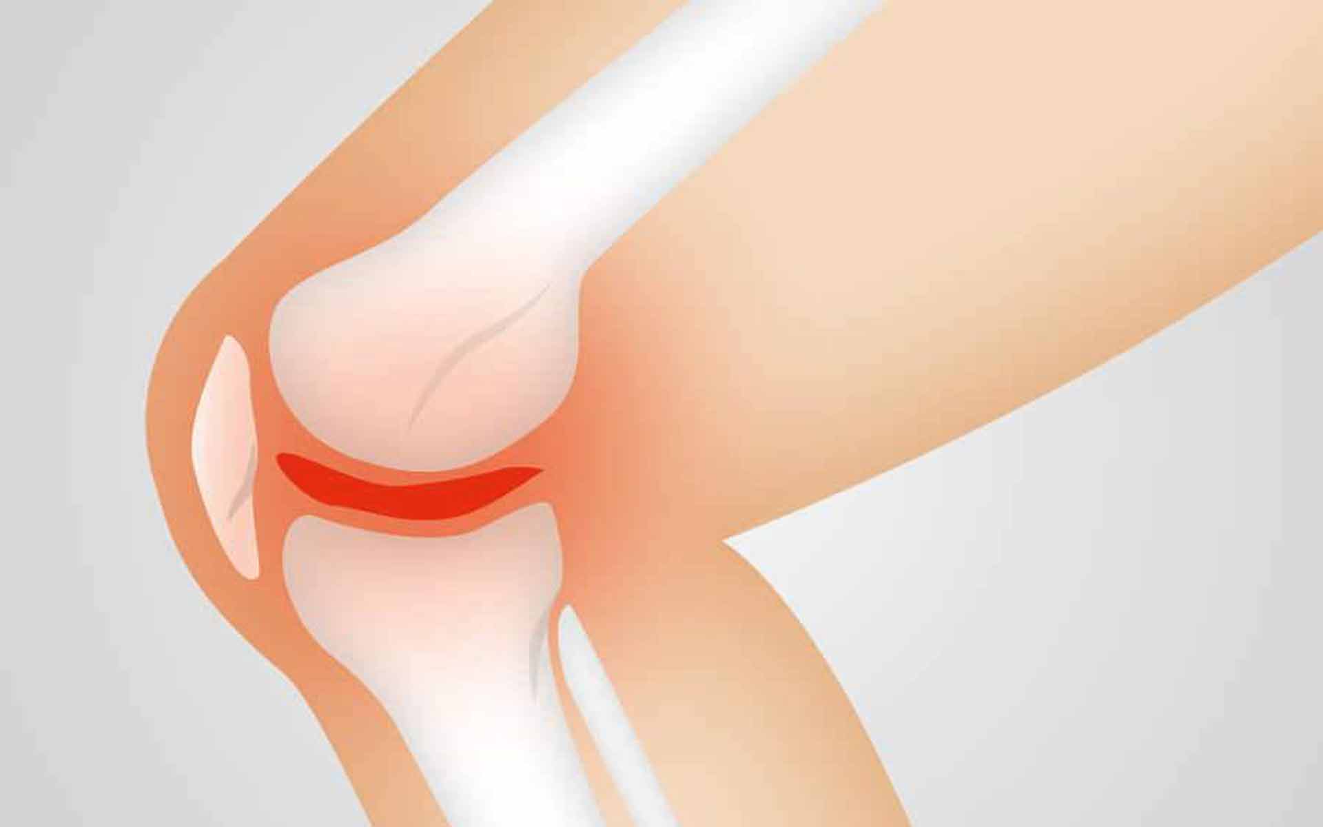 Síntomas, causas y factores de riesgo en esguinces de rodilla