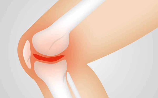 Síntomas, causas y factores de riesgo en esguinces de rodilla