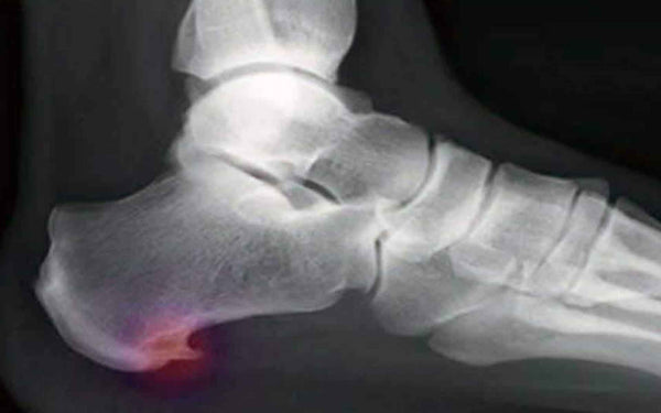 radiografia espolon calcaneo