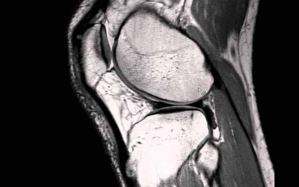 resonancia rodilla menisco